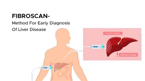 FibroScan® and Liver Disease .